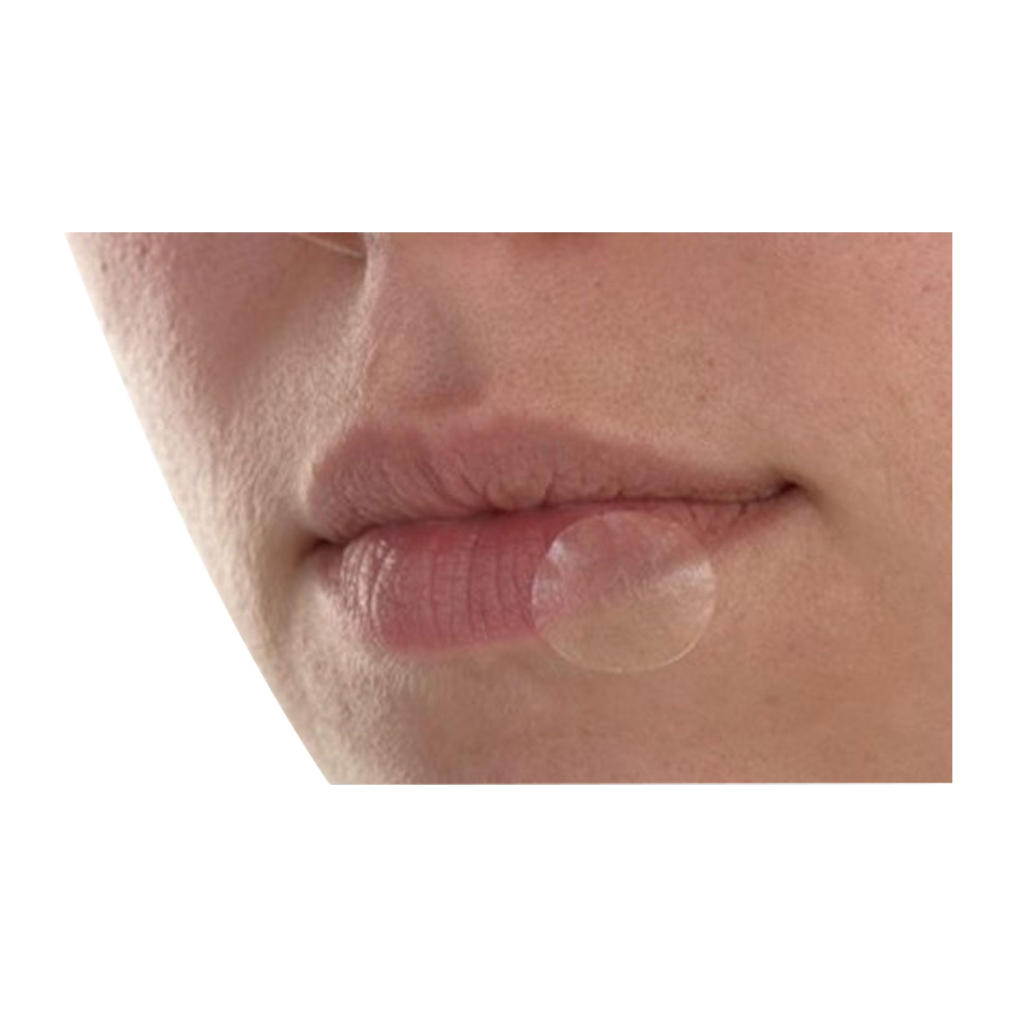 Herpes Patchbei bei Lippenherpes 15 mm
